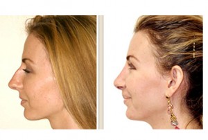 before_after_plastic_surgery_military